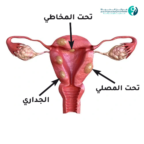 شكل الورم الليفي في الرحم